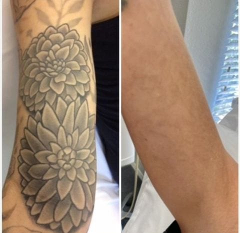 PERMANENT TATTOO REMOVAL CREAM +27799196969 ZAMBIA, KENYA, GHANA, NIGERIA, TOGO - Auditor in Asaripallam